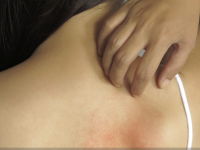 Vous souffrez d'eczéma et même l'été ne vous laisse aucun répit ?