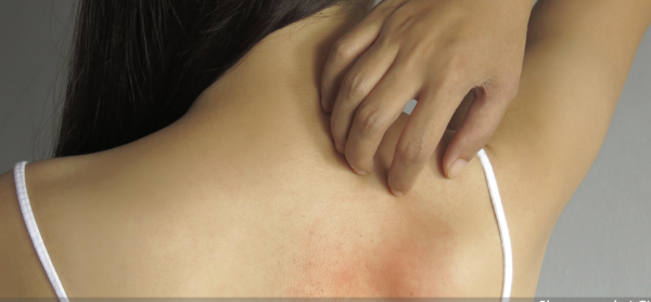 Vous souffrez d'eczéma et même l'été ne vous laisse aucun répit ?